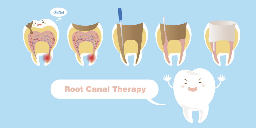 Brighten Up That Beautiful Smile Today With Root Canal Therapy 