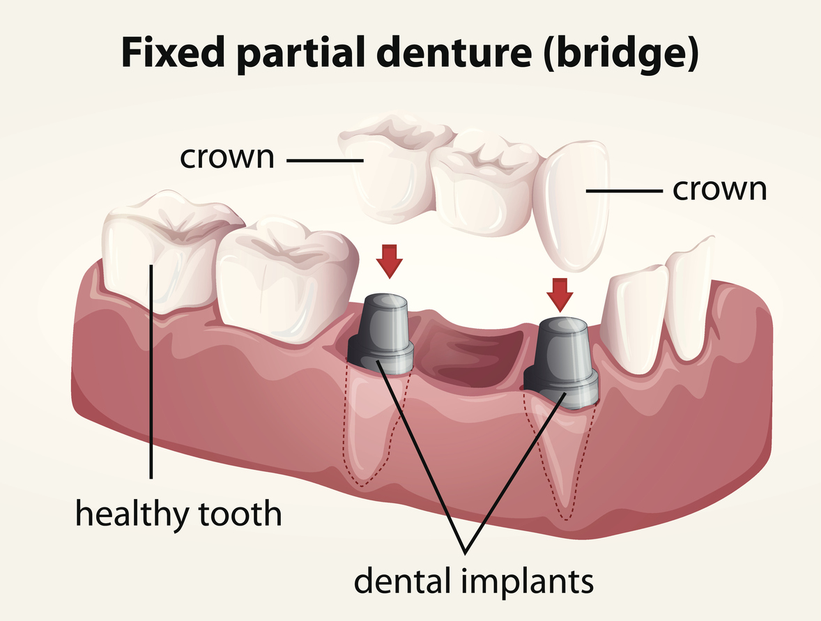 Dental Pain