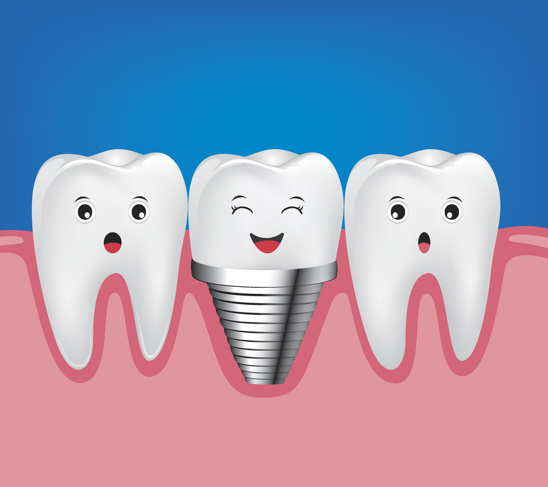 Dental implant and normal tooth beautiful bright.
