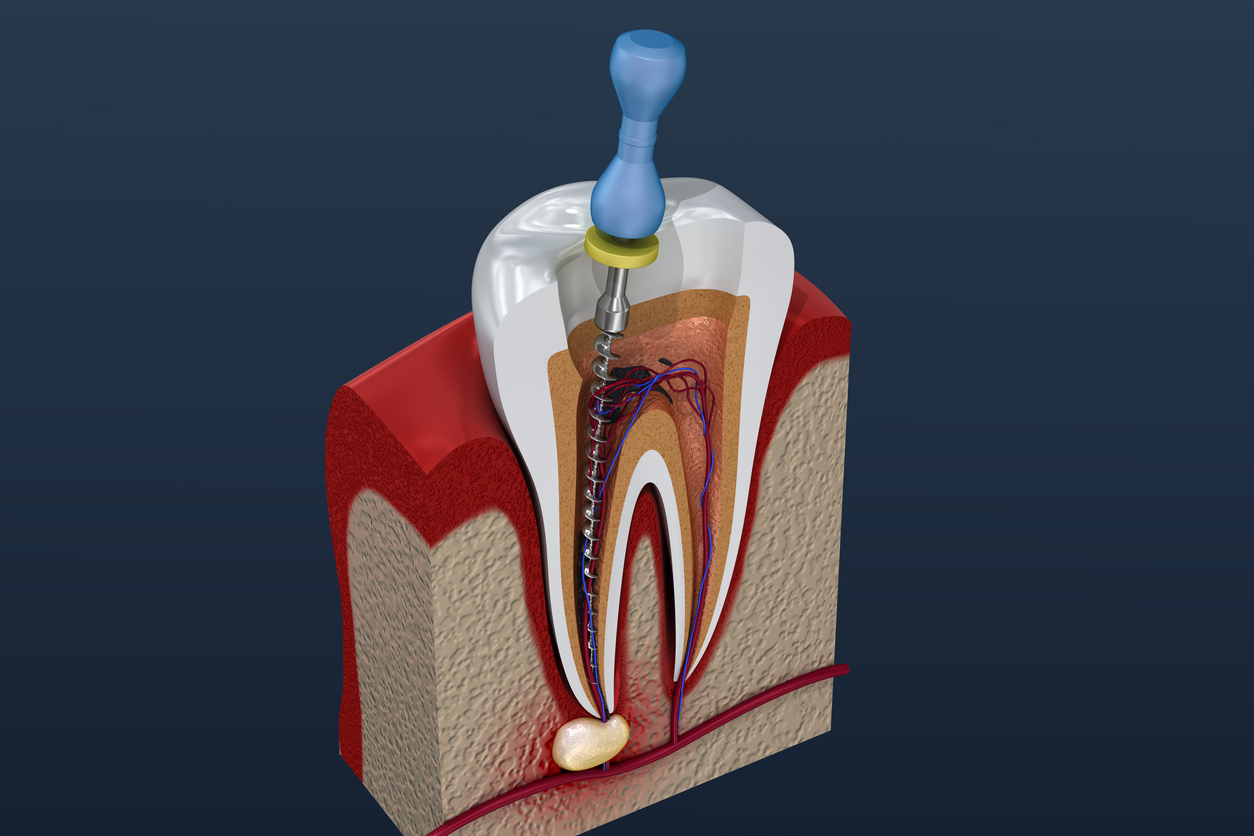 abscess tooth drain