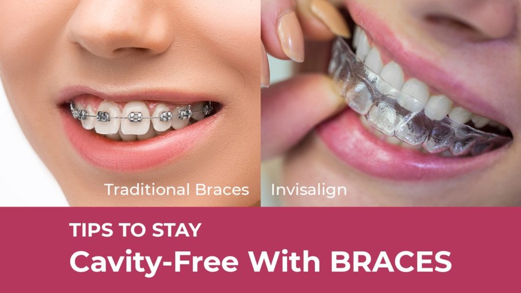 Tips To Stay Cavity Free With Braces | Springvale Dental Blog