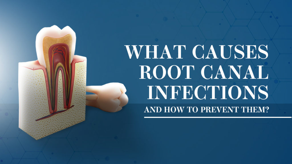 root-canal-infection-cause-and-prevention-springvale-dental-clinic