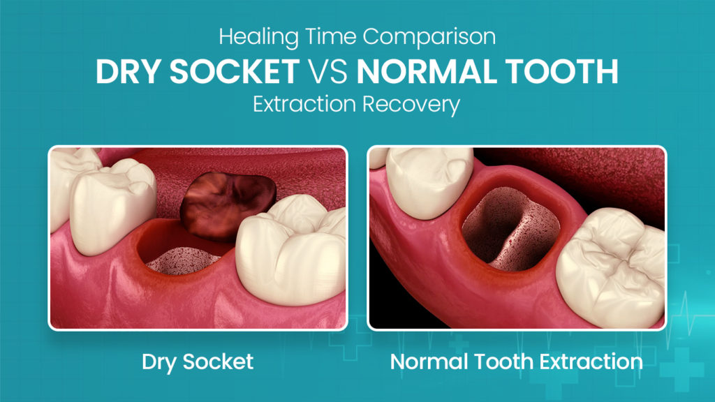 Recovery Time Of Dry Socket Vs Normal Tooth Extraction