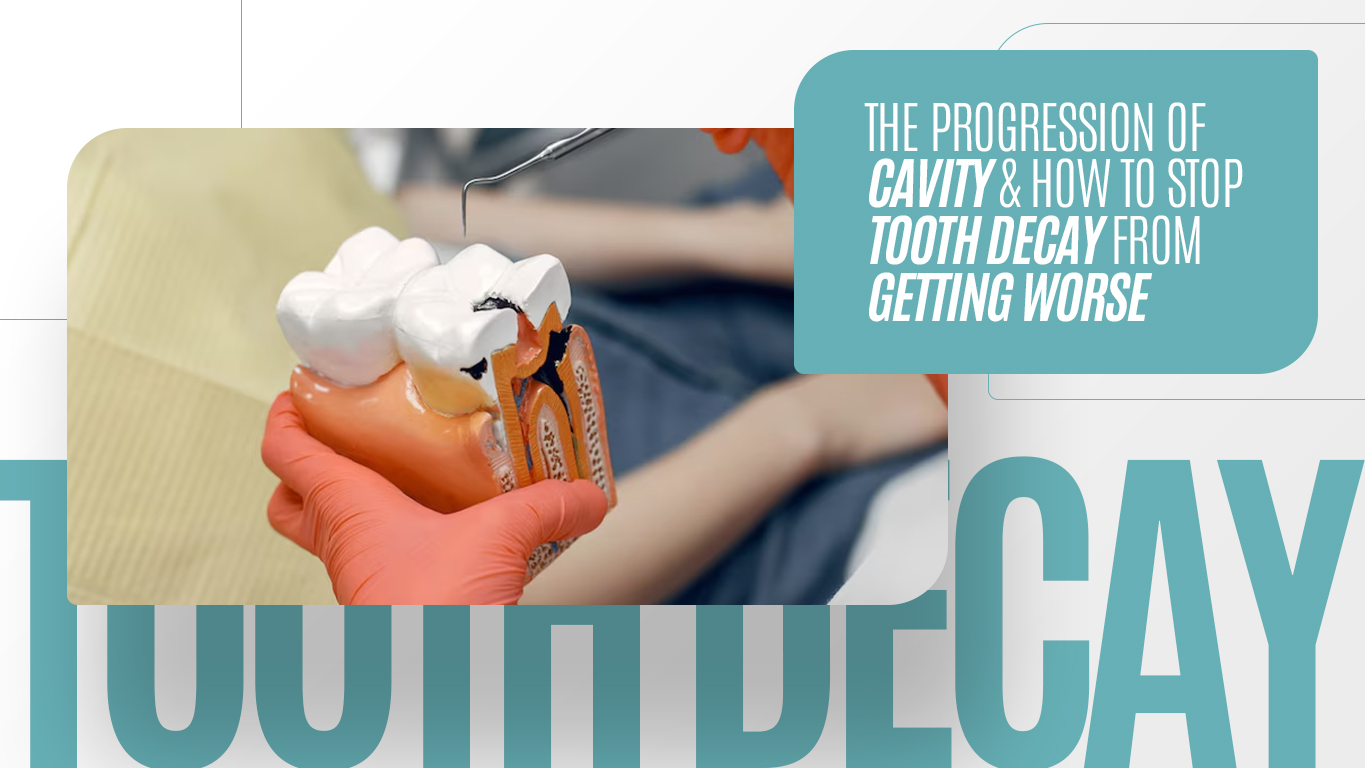 The Progression of Cavity and How to Stop Tooth Decay